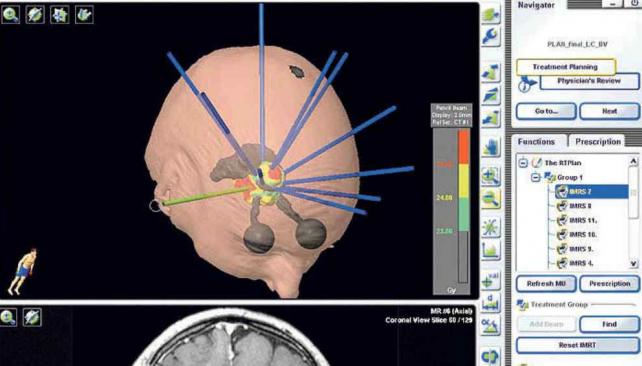 Radiocirugía Novalis en tumor intracraneal.